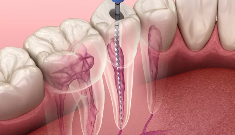 Эндодонтическое лечение со скидкой 10%