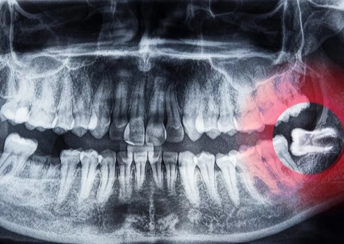 Удаление зубов мудрости III сложности со скидкой 20%