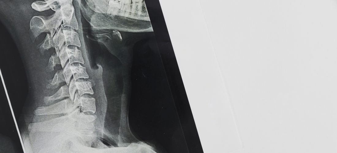 Перелом шейного позвонка: особенности, диагностика, лечение