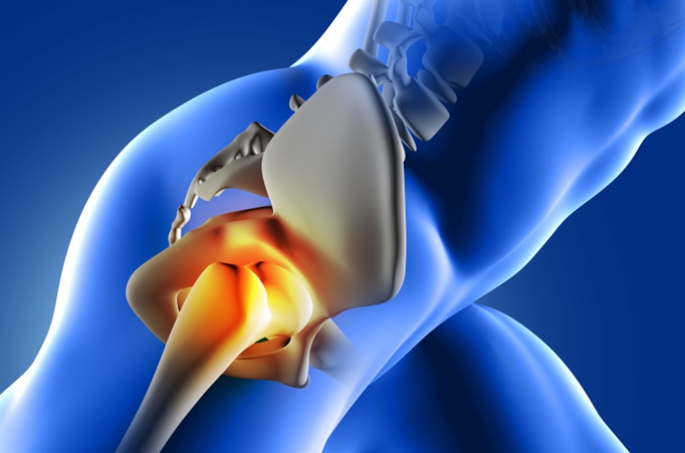 Классификация и стадии некроза бедра