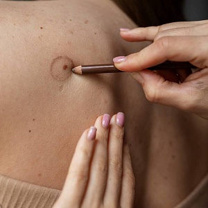 Фиброма кожи: причины, виды, лечение