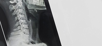 Перелом шейного позвонка: особенности, диагностика, лечение