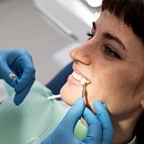 Керамическая вкладка: назначение, преимущества, этапы установки