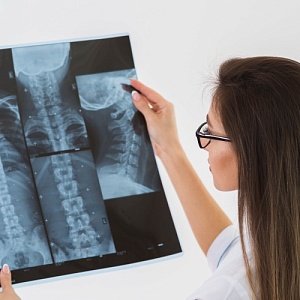 Компрессионный перелом грудного позвонка: причины, симптомы и лечение