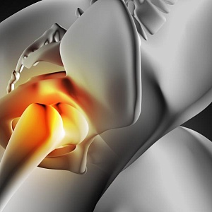 Некроз головки бедра: диагностика, лечение, прогноз