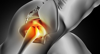 Некроз головки бедра: диагностика, лечение, прогноз