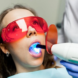 Чистка зубов ультразвуком: показания и этапы