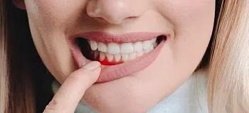 Почему кровоточат десны: чего не хватает организму и как их лечить?
