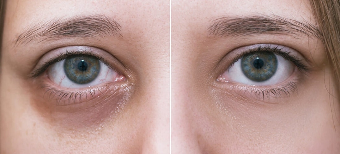 Как убрать синяки под глазами и почему они появляются?