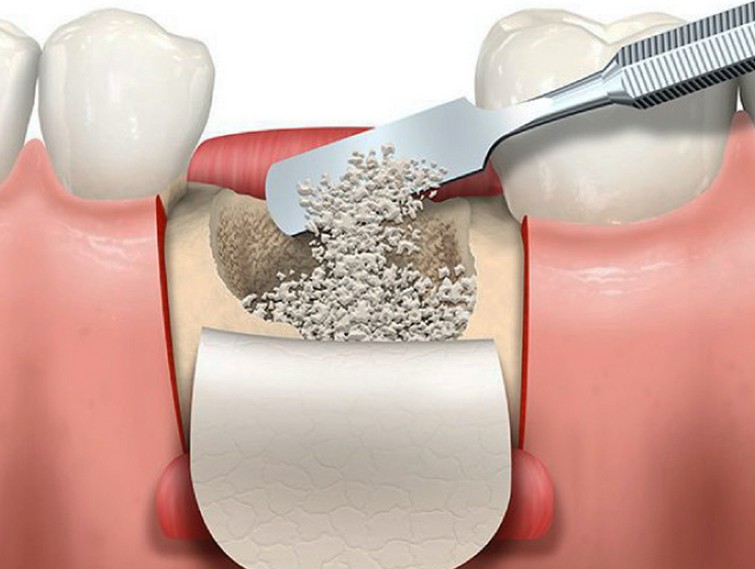 Способы наращивания кости