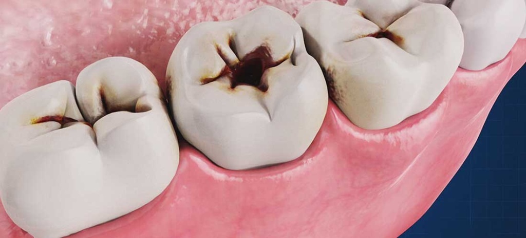 Твердые ткани зуба: основные патологии и их лечение
