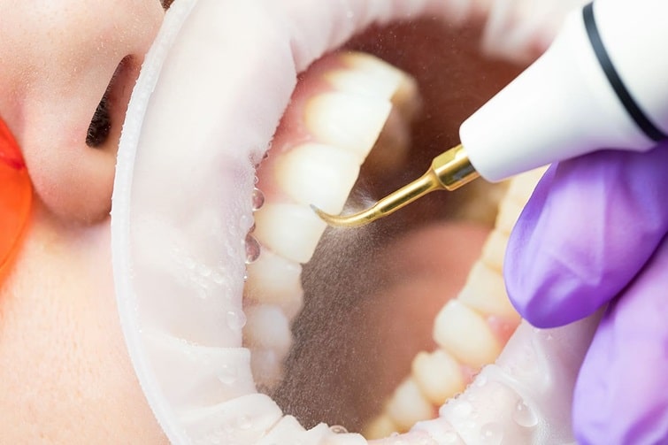 Этапы удаления зубного налета и дальнейший уход