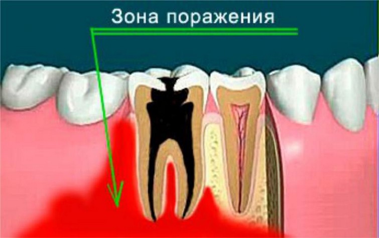 Причины развития остеомиелита челюсти