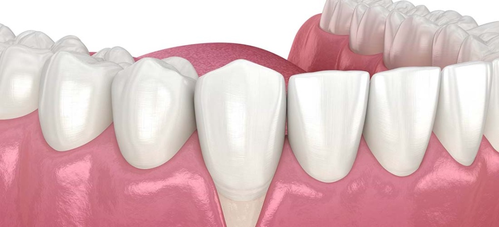 Десна отошла от зуба: лечение и профилактика патологии