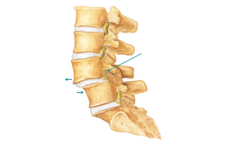 Диагностика и лечение ретролистеза позвонка