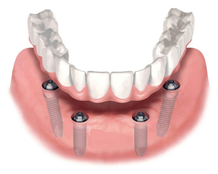 Этапы имплантации на 4 имплантах