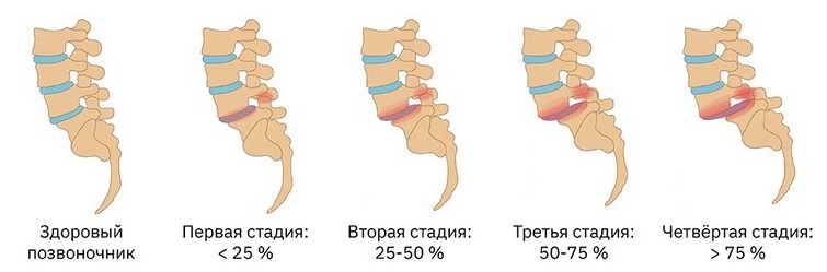 виды спондилолистеза