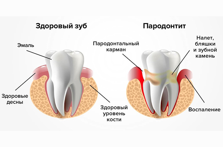 Пародонтит и его причины