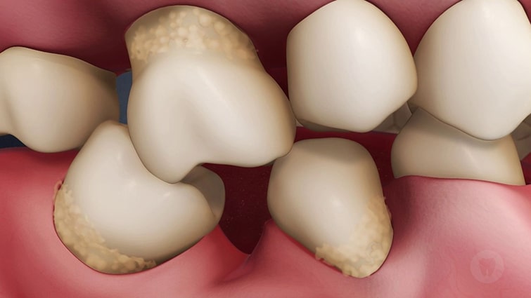 Последствия отсутствия верхних зубов