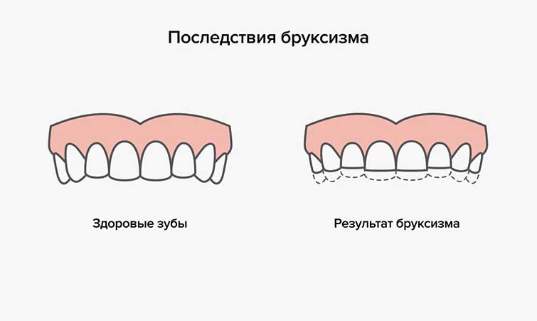 Что такое бруксизм и как его лечить