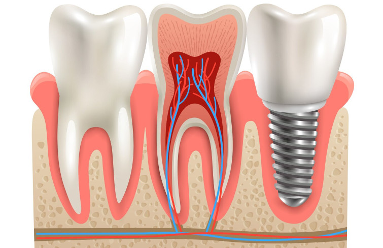 Плюсы и минусы импланта зуба