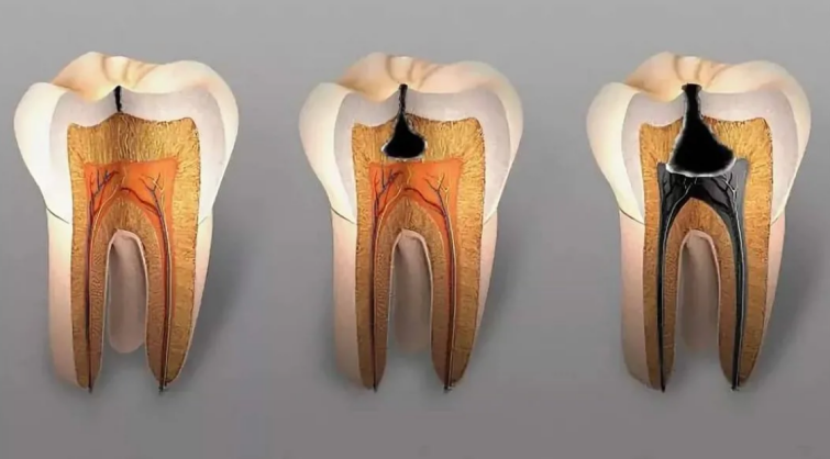 Процесс разрушения зуба