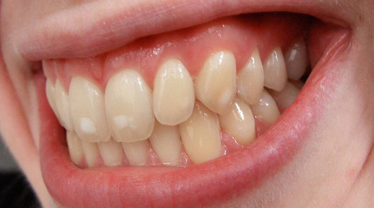 Белые пятна на передних зубах