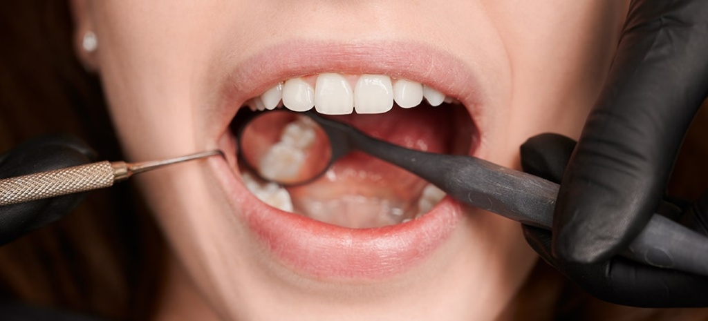 Темные пятна на зубах: причины, лечение, профилактика