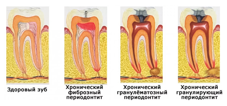 Лечение периодонтита