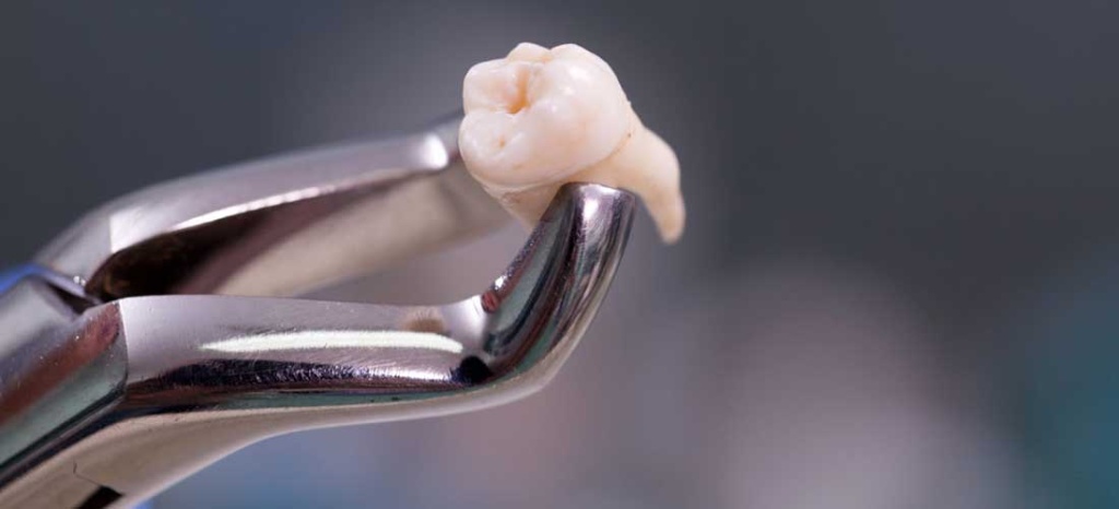 Когда удаляют зуб и как избежать осложнений