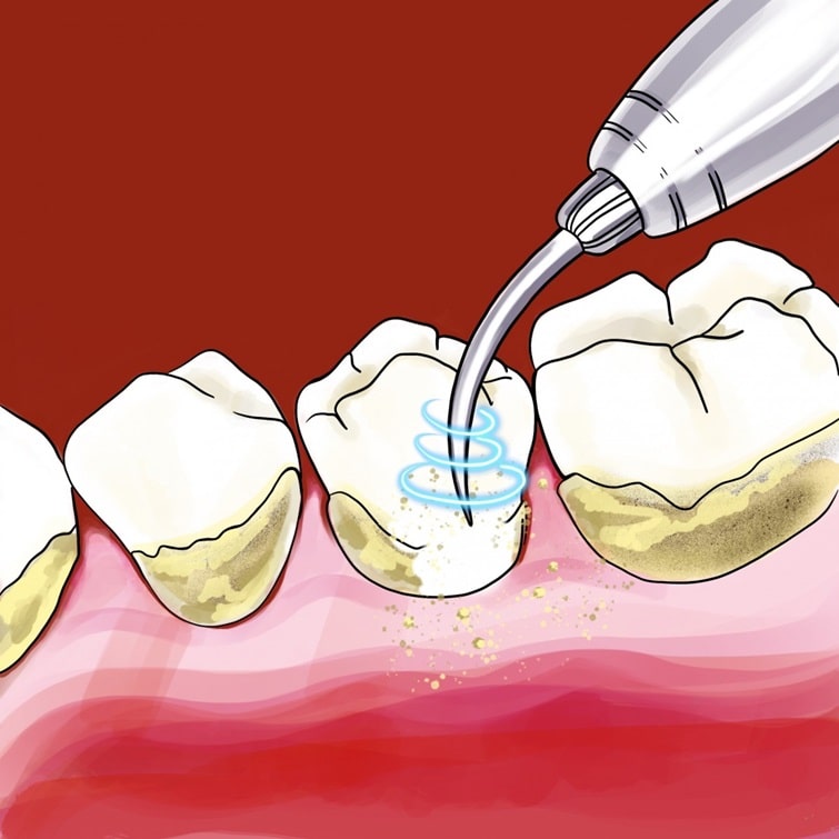 Методы удаления зубных отложений