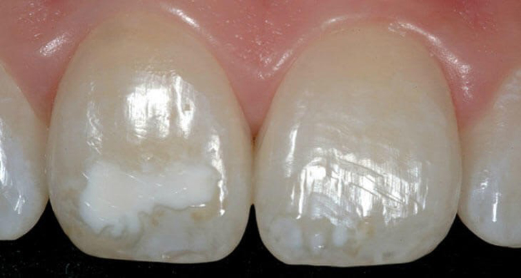 Белые пятна на передних зубах