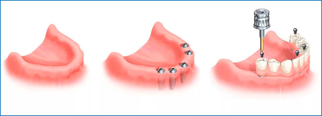 Особенности имплантации нижних жевательных зубов