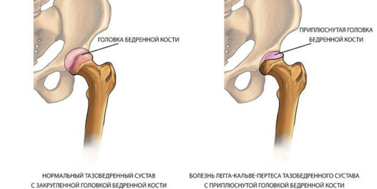 Общие сведения о болезни Пертеса
