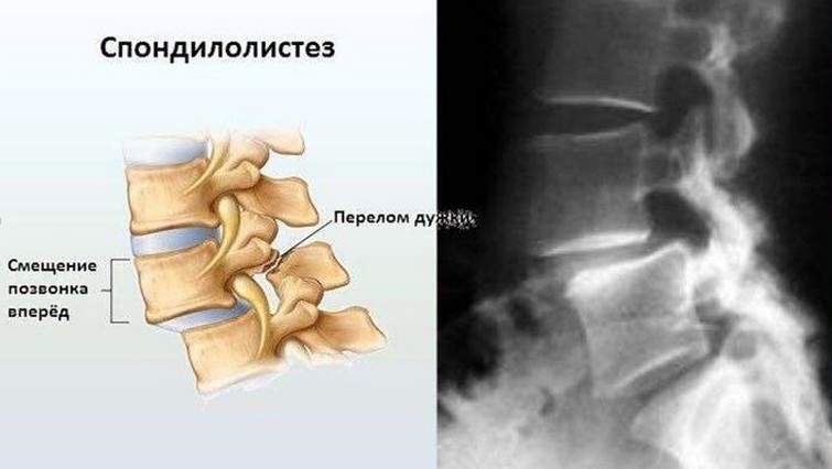 Общие сведения о спондилолистезе позвоночника