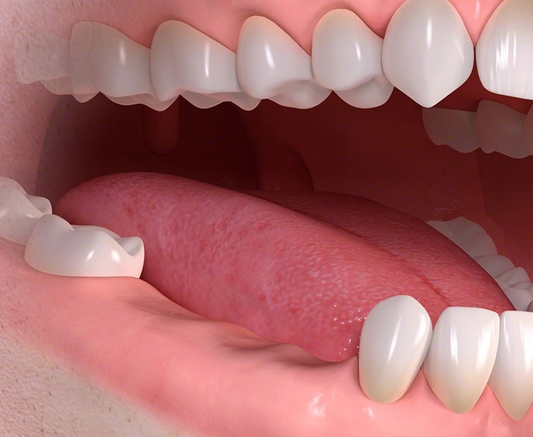Частичное отсутствие зубов