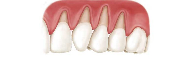 Причины рецессии десен и ее последствия