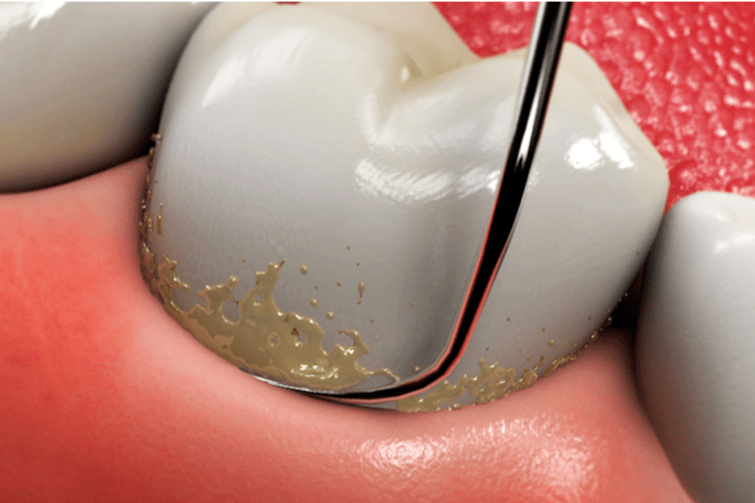 Особенности зубных отложений