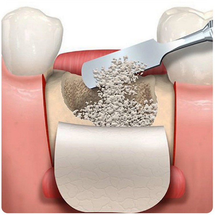 Методы предотвращения атрофии кости после удаления зуба