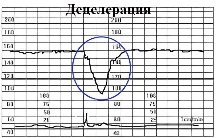 Значения и показатели КТГ, интерпретация и оценка результатов при различных патологиях