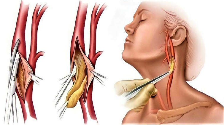 Что собой представляет аневризма сонной артерии