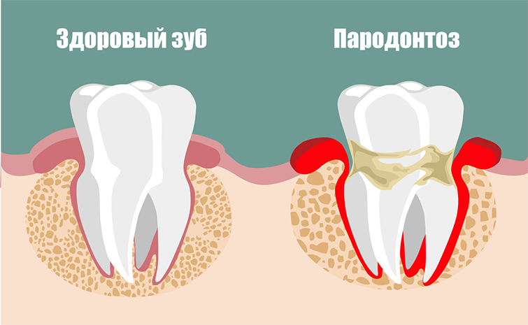 Что такое пародонтоз