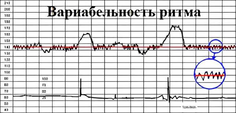 Значения и показатели графика КТГ, расшифровка и оценка результатов