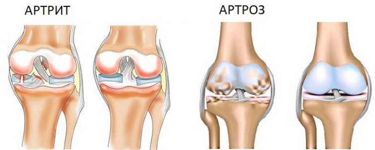 Методы профилактики артрита и артроза