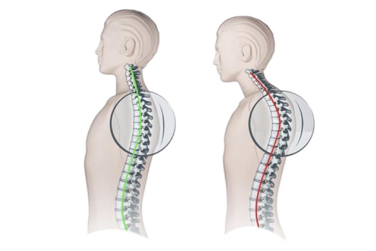 Грудной кифоз позвоночника и его виды