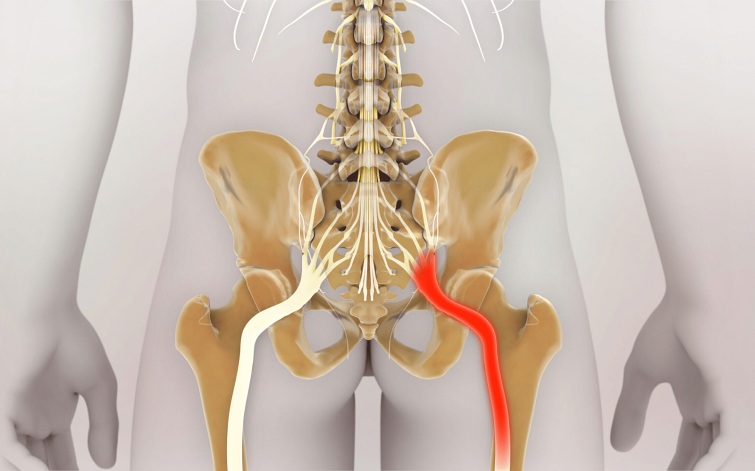 Диагностика ишиаса