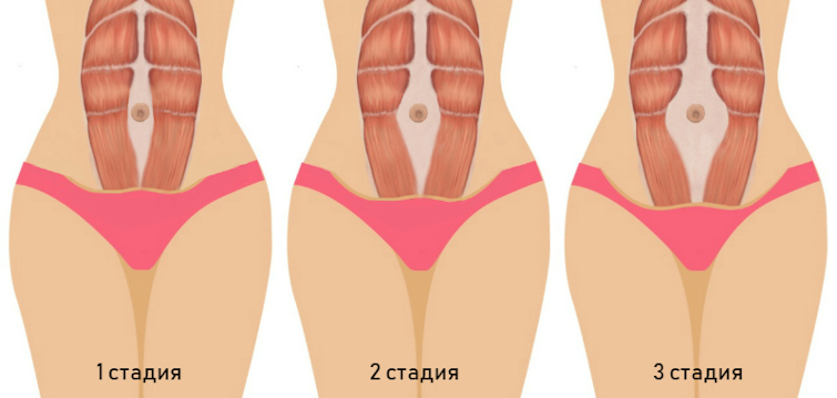 Виды расхождения мышц