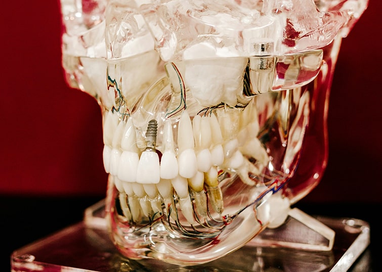 Причины отсутствия верхних зубов