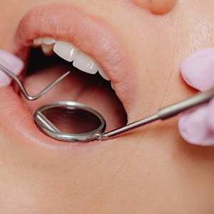 Откололась стенка зуба: причины, симптомы, восстановление