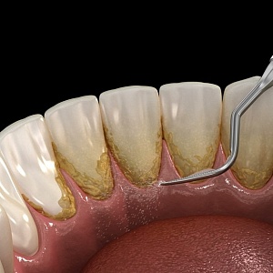 Удаление зубных отложений: все возможные методы